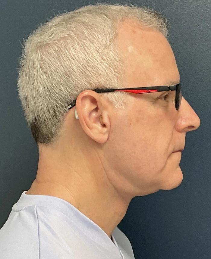 Neck Lift case #18831