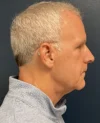 Neck Lift case #18831