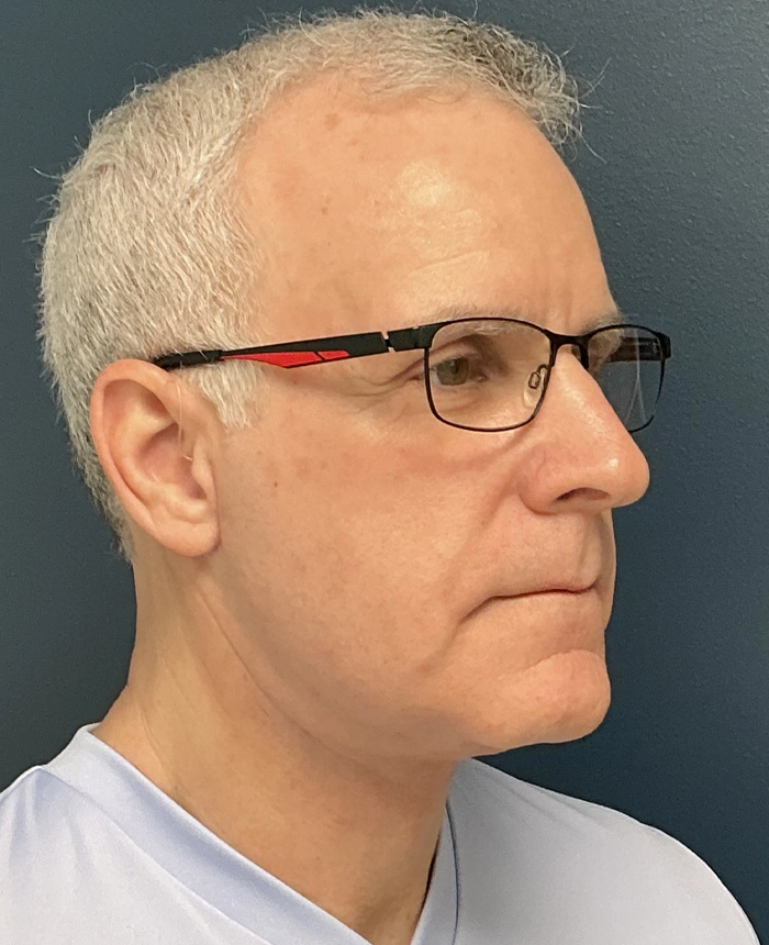 Neck Lift case #18831
