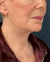 Facelift case #18828