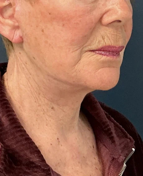 Facelift case #18828