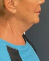 Facelift case #18828