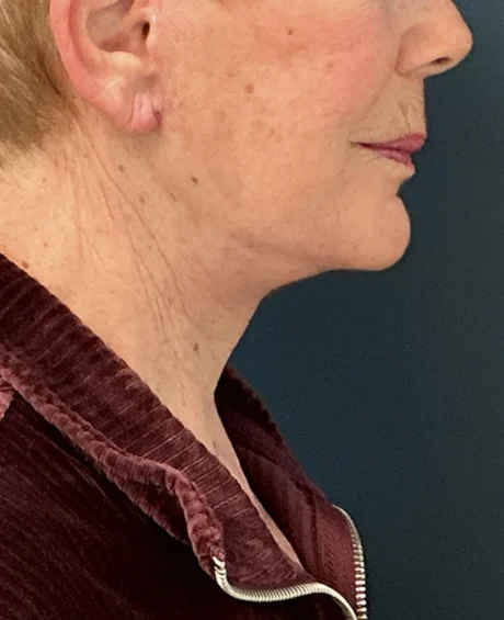 Facelift case #18828