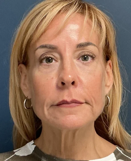 Eyelid Surgery case #18829