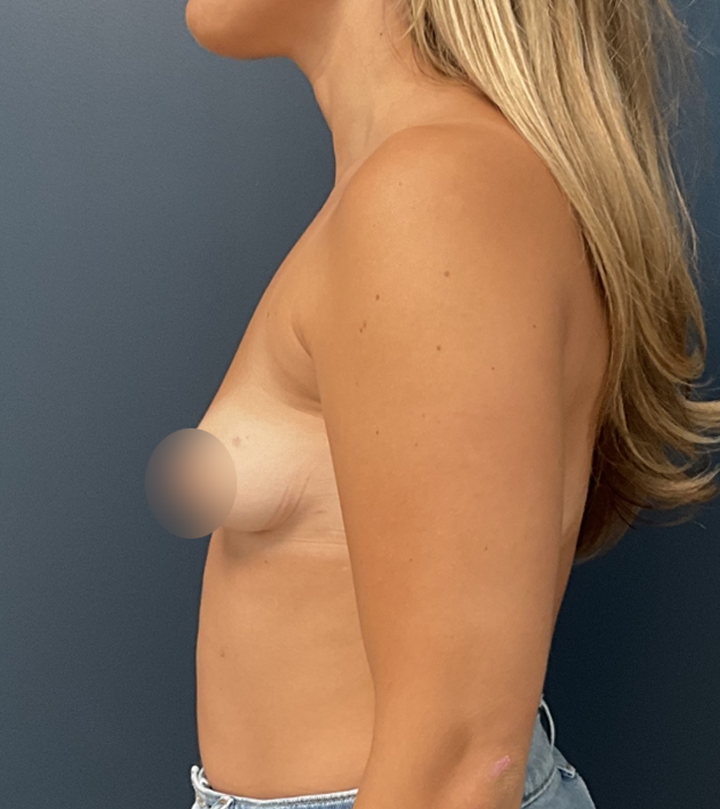 Breast Augmentation case #18758