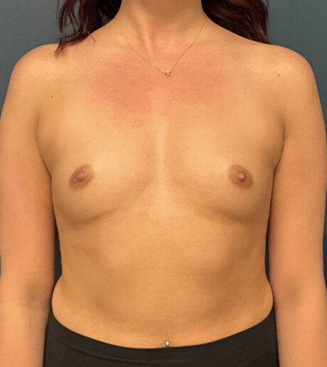 Breast Augmentation case #18943