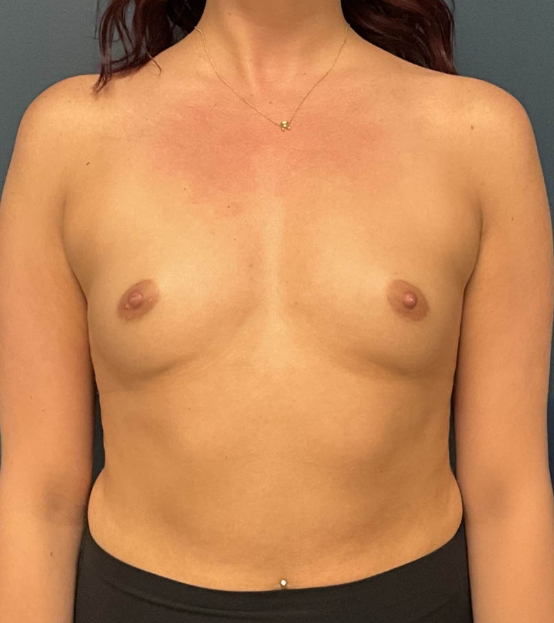 Breast Augmentation case #18943