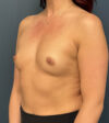 Breast Augmentation case #18943