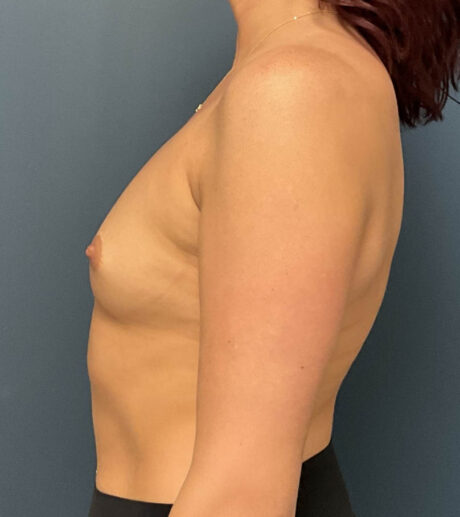 Breast Augmentation case #18943