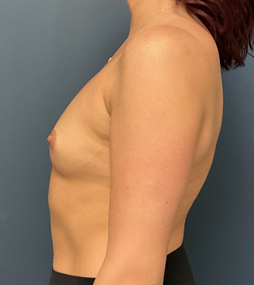 Breast Augmentation case #18943