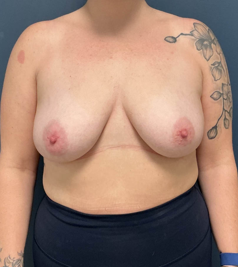 Breast Augmentation case #18556