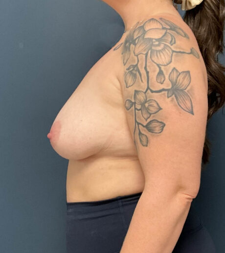 Breast Augmentation case #18556