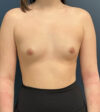Breast Augmentation case #18570