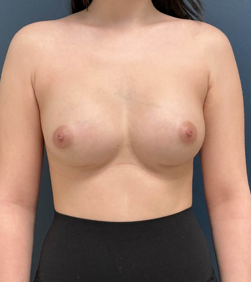 Breast Augmentation case #18570