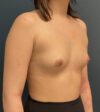 Breast Augmentation case #18570