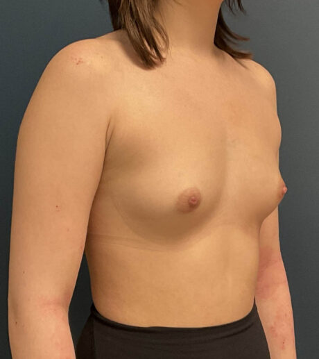 Breast Augmentation case #18570