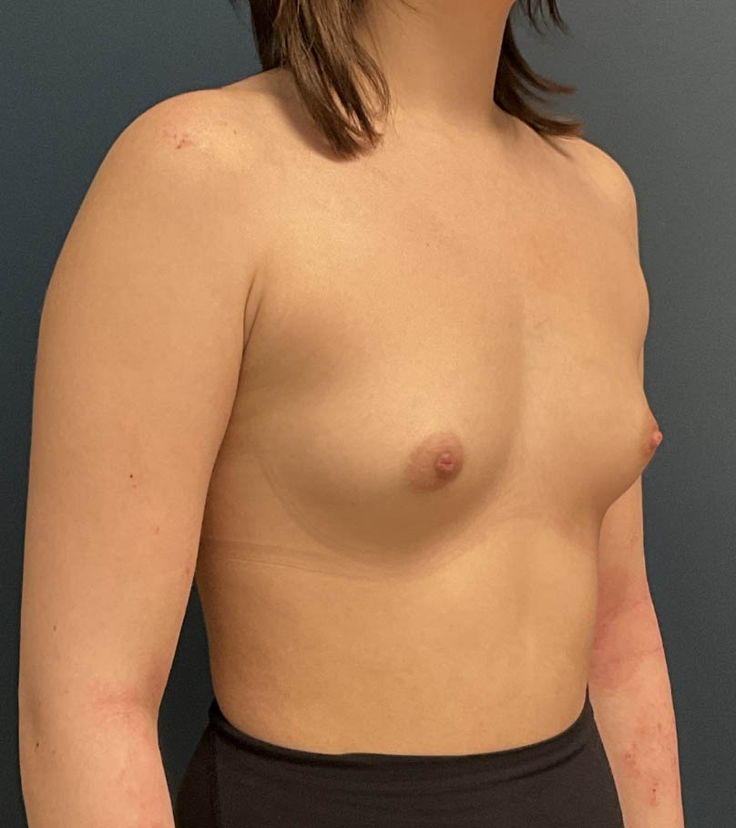 Breast Augmentation case #18570