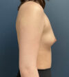 Breast Augmentation case #18570