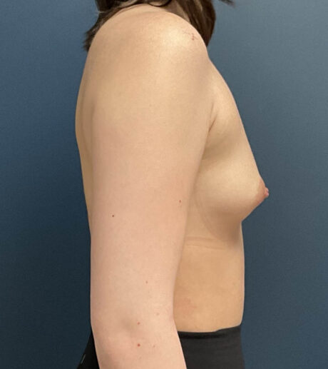 Breast Augmentation case #18570