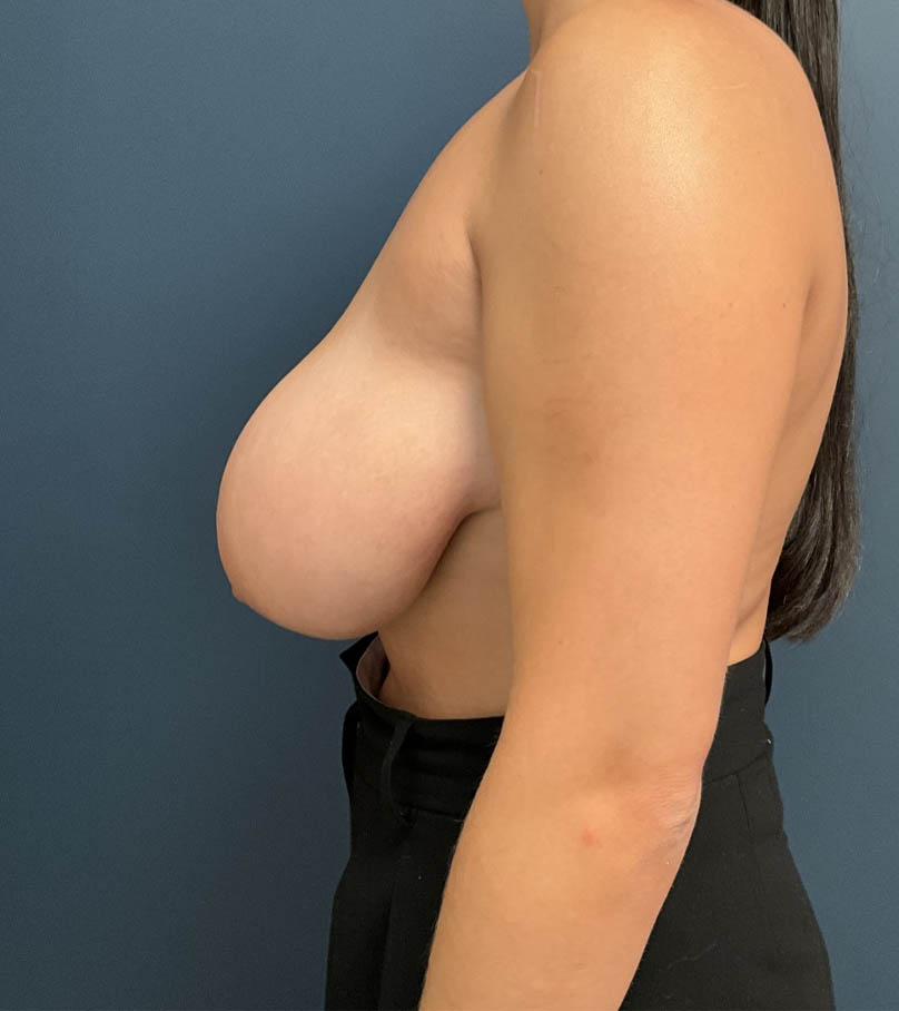 Breast Lift case #18584