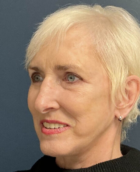 Eyelid Surgery case #18465