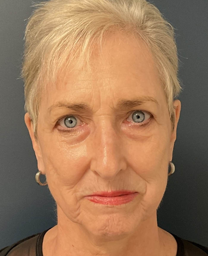 Eyelid Surgery case #18465