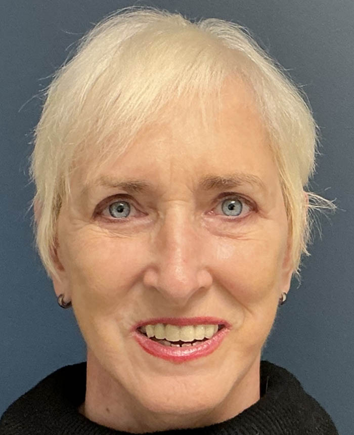 Eyelid Surgery case #18465