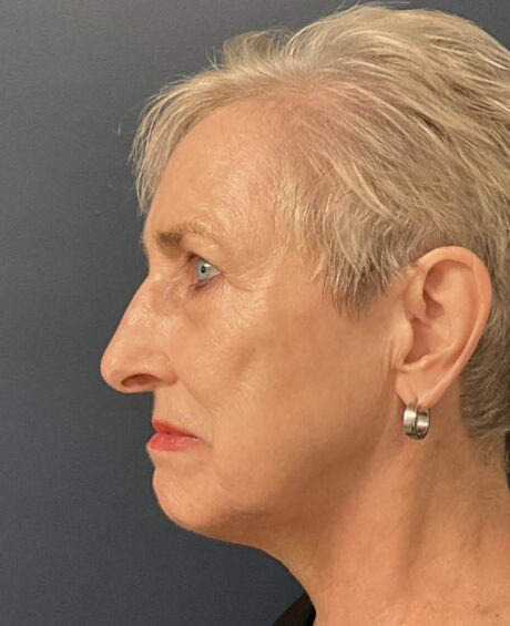 Eyelid Surgery case #18465