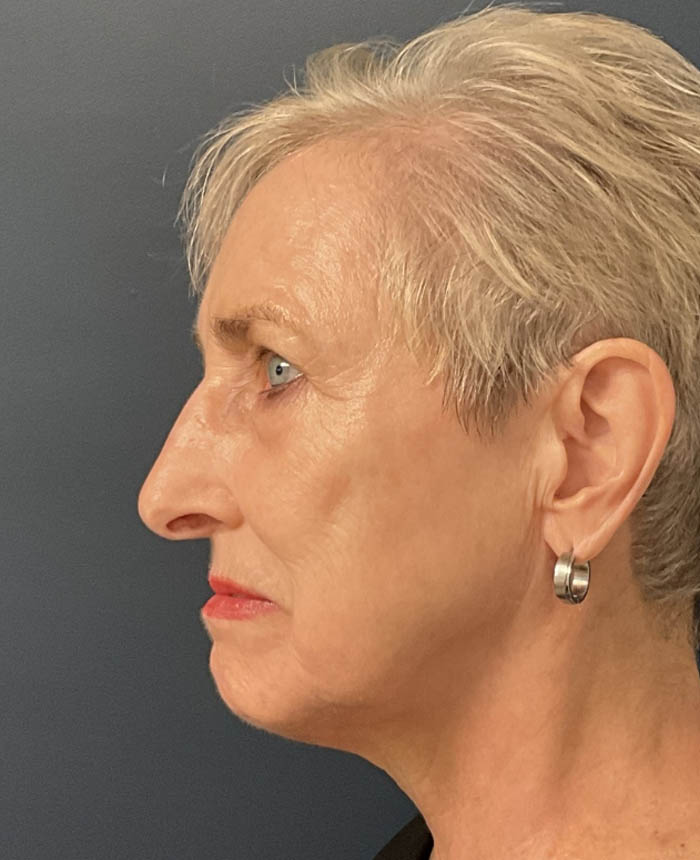 Eyelid Surgery case #18465