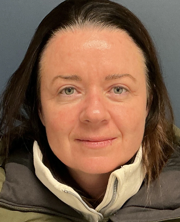 Eyelid Surgery case #18494