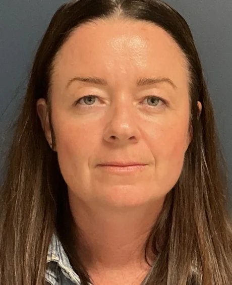 Eyelid Surgery case #18494