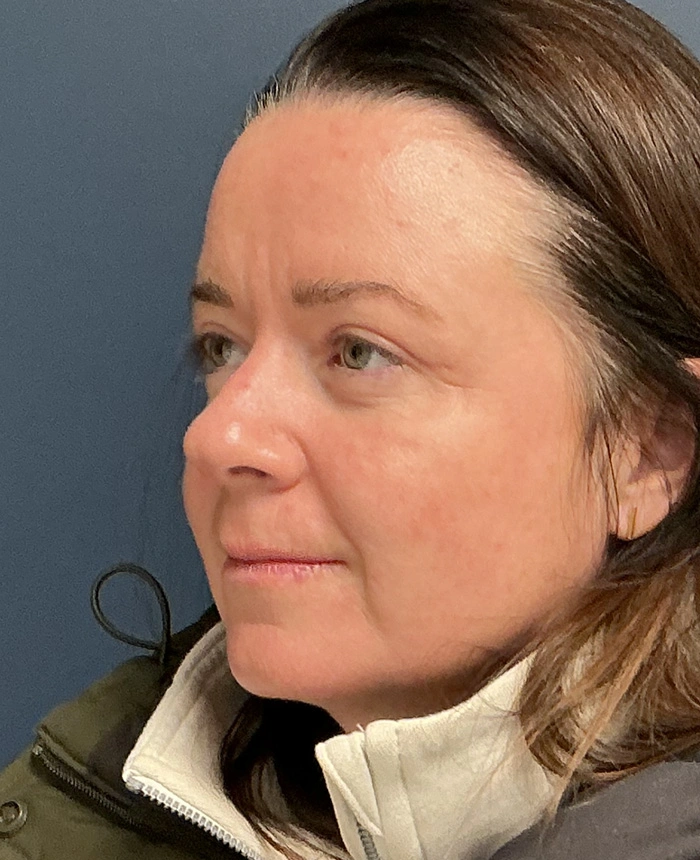 Eyelid Surgery case #18494