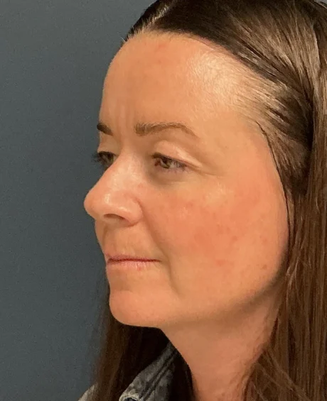 Eyelid Surgery case #18494