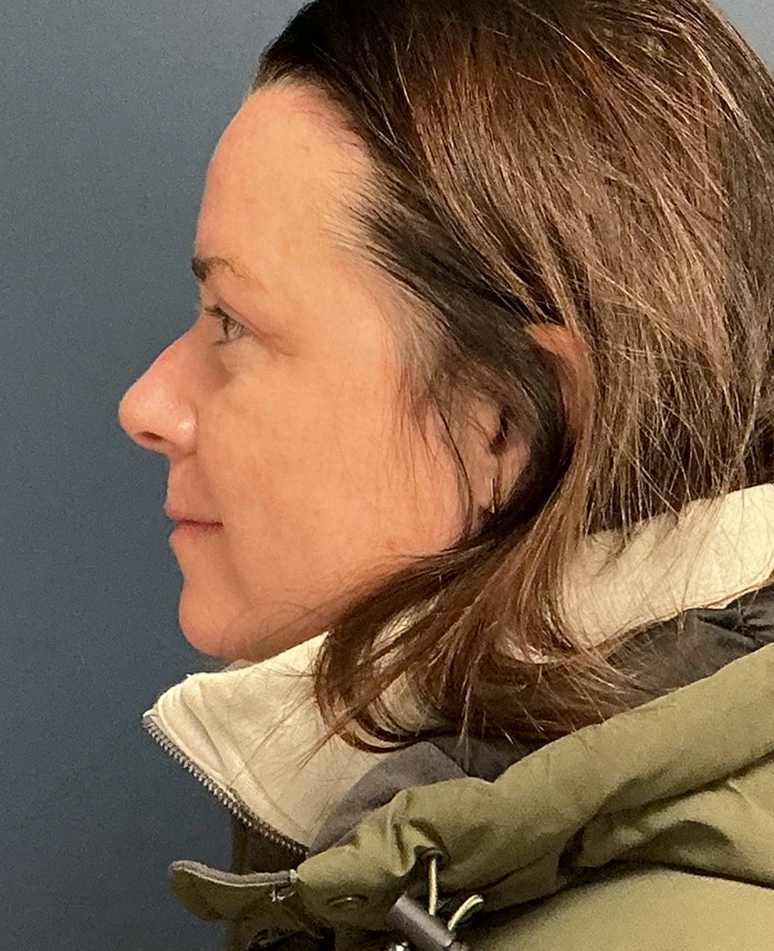 Eyelid Surgery case #18494