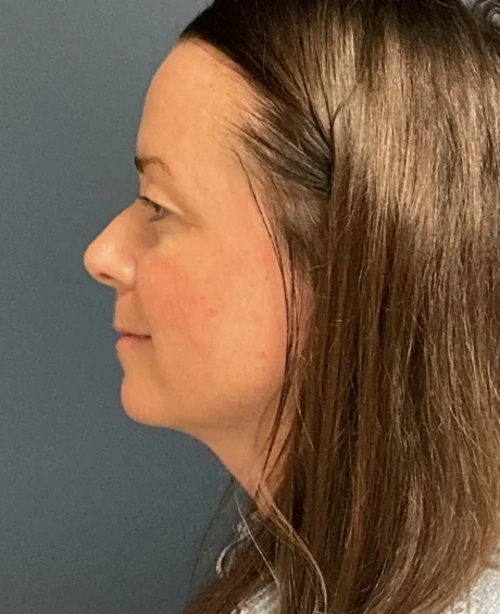 Eyelid Surgery case #18494