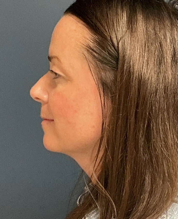 Eyelid Surgery case #18494