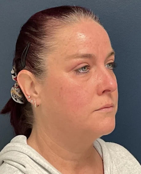 Eyelid Surgery case #18501