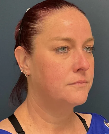 Eyelid Surgery case #18501