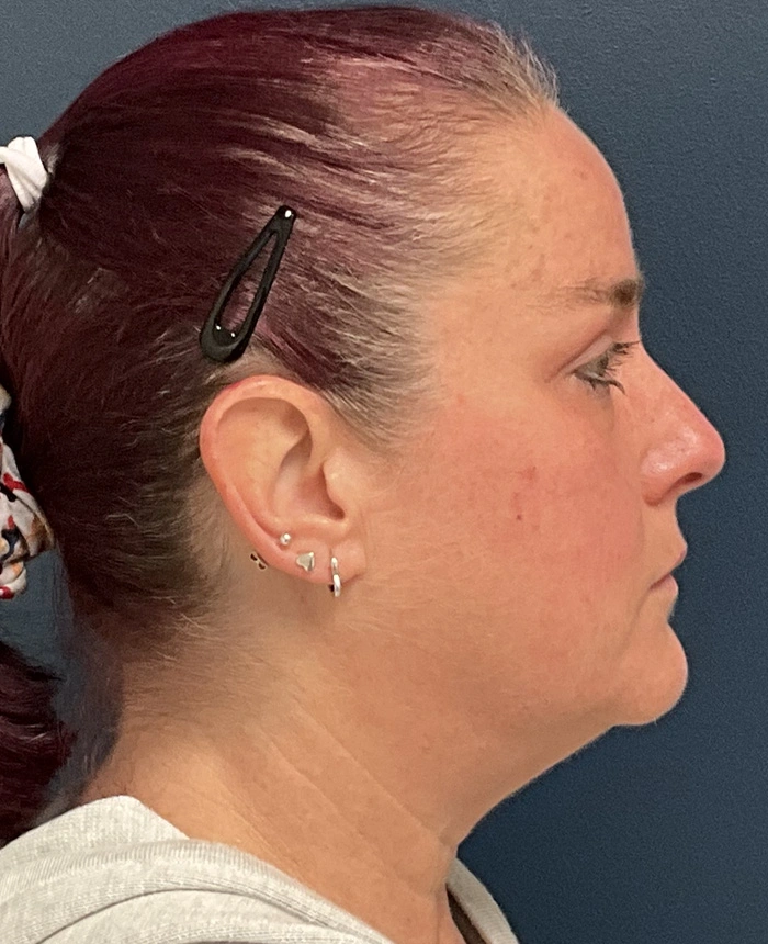 Eyelid Surgery case #18501