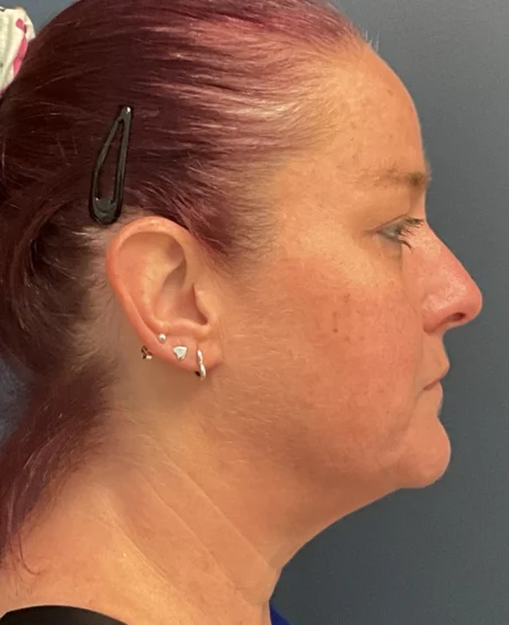 Eyelid Surgery case #18501