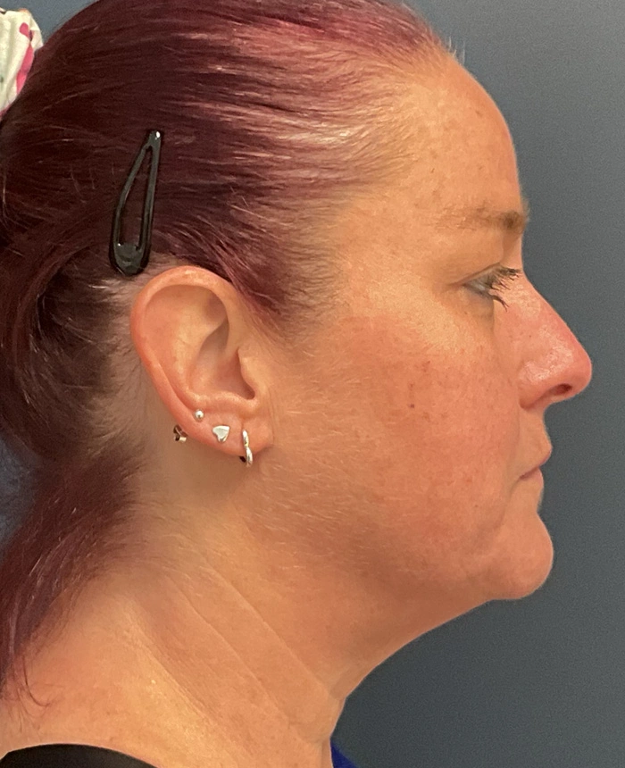 Eyelid Surgery case #18501