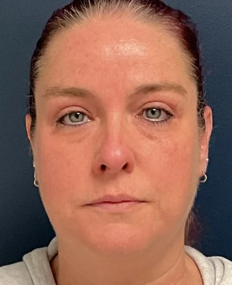 Eyelid Surgery case #18501