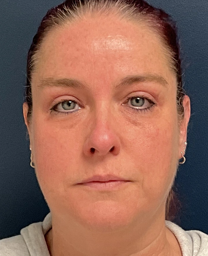 Eyelid Surgery case #18501