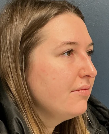 Eyelid Surgery case #18508