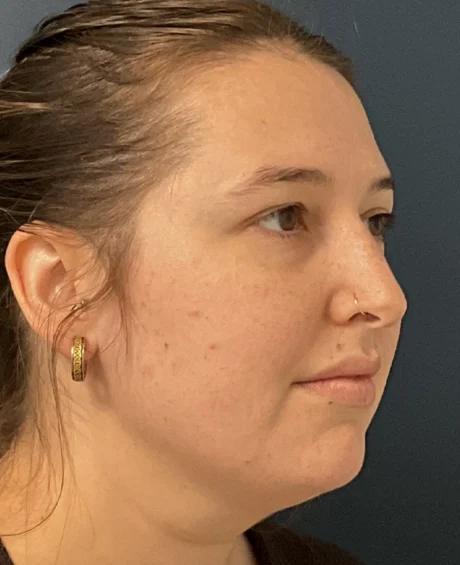 Eyelid Surgery case #18508