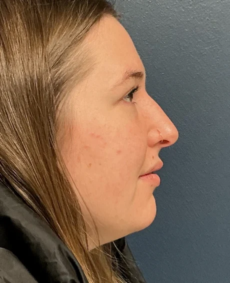 Eyelid Surgery case #18508