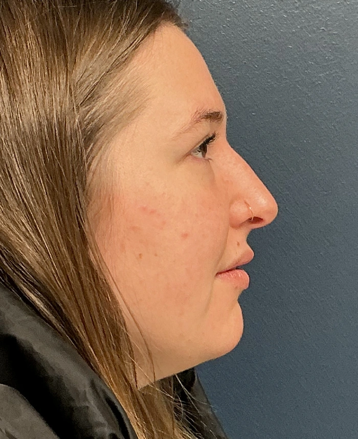 Eyelid Surgery case #18508
