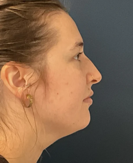 Eyelid Surgery case #18508