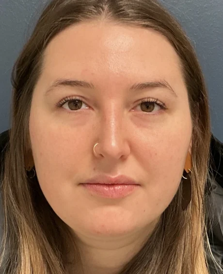 Eyelid Surgery case #18508