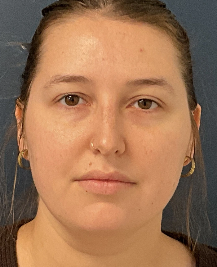 Eyelid Surgery case #18508